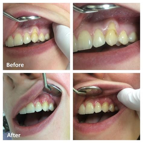 Gum Grafts Ottawa Periodontal Surgery For Receding Gums