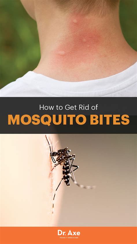 How To Get Rid Of Mosquito Bites Home Mosquitoes Bites And Mosquitoes