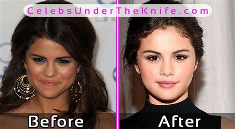 selena gomez plastic surgery photos before after