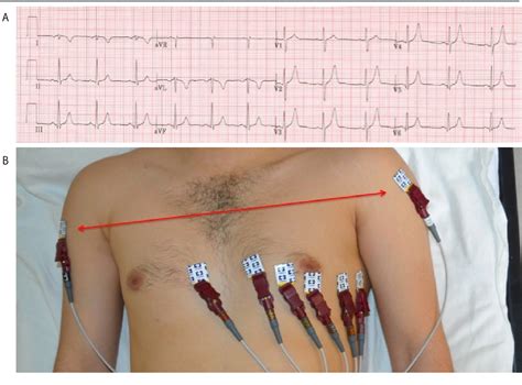 Figure 2 From Common Ecg Lead Placement Errors Part I