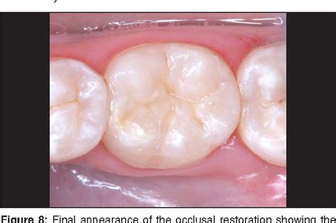 Figure 8 From Restoration Of Posterior Teeth Using Occlusal Matrix