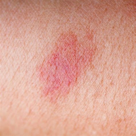 10 Symptoms Of Psoriasis Rm Healthy Red Skin Patches