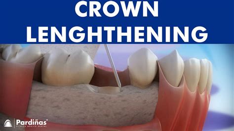 Dental Crown Lengthening © Youtube