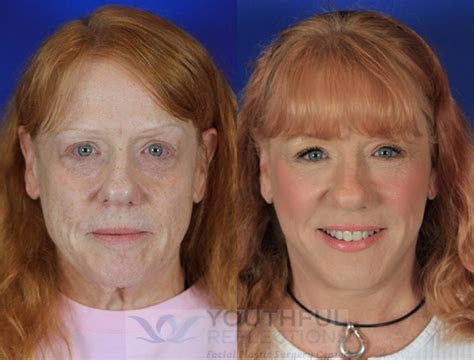 Co2 Laser Skin Resurfacing Before And After Photos Patient 3 Nashville
