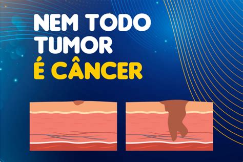 Nem Todo Tumor é Câncer Centro De Diagnóstico Santa Clara