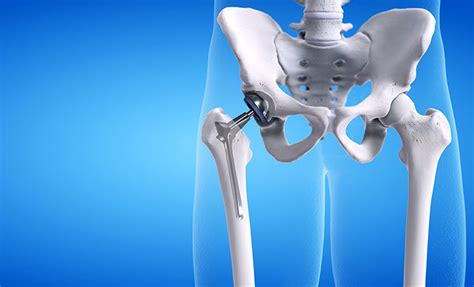 What Is A Total Hip Replacement Cary Orthopaedics