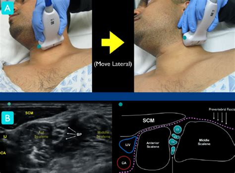 How To Perform Ultrasound Guided Interscalene Nerve Blocks Acep Now
