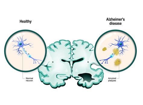 Alzheimer Plaque Affects Different Brain Cells Differently Research And Development World