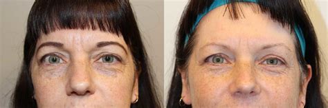 Eyelid Surgery (Blepharoplasty) Before and After Photos
