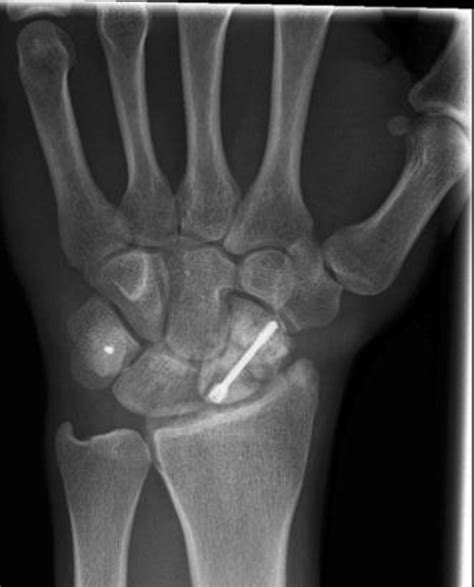 Wrist Pa X Ray At 12 Months Suggesting Non Union Of Scaphoid Fracture