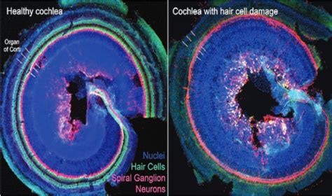 Regeneration Of Auditory Hair Cells A Potential Treatment For Hearing