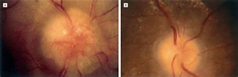The Pathogenesis And Treatment Of Optic Disc Swelling In