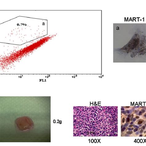 Expression Of Cd133 In Human Melanoma Biopsies Seven And