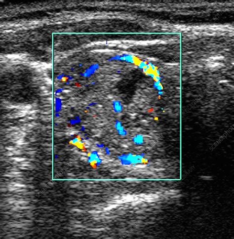 Thyroid Adenoma Ultrasound Scan Stock Image C0071654 Science