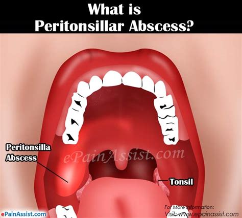 What Is Peritonsillar Abscess Or Quinsycausessymptomstreatment