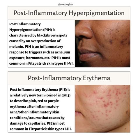 Roadtoglows Instagram Post “🔍 Post Inflammatory Hyperpigmentation Vs