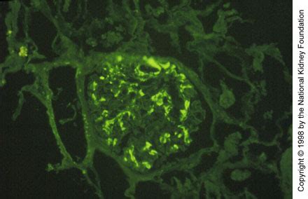 Maybe you would like to learn more about one of these? Nefropatía por inmunoglobulina A - Trastornos urogenitales ...