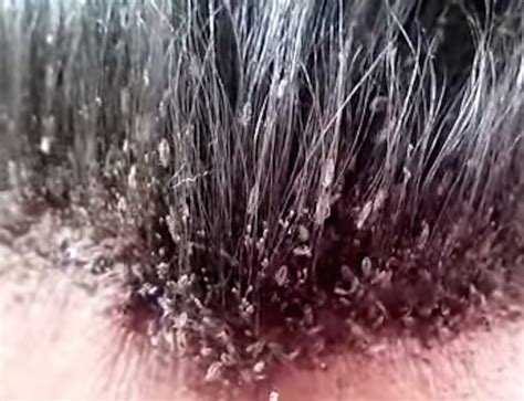 This makes the lice and nits more visible. The Man With The World's Worst Head Lice Infestation Is ...