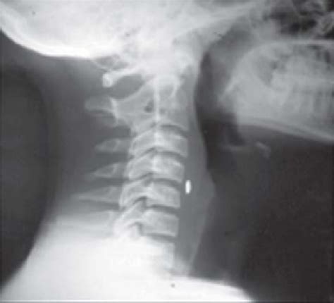 Preoperative X Ray Neck Showing Radiopaque Foreign Body In The