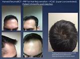 Hair Loss Treatment Chicago Pictures