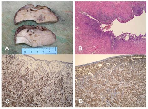 Grossly The Tumor Was White Gray In Color And The Cut Surface