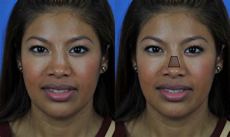 Rhinoplasty Surgery For Saddle Nose Deformity In San Diego Ca Dr