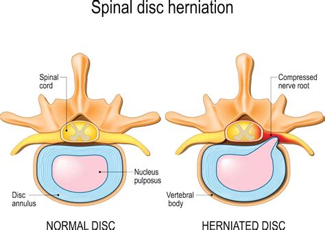 What Is A Bulging Disc What Causes It Perthchiro Centre