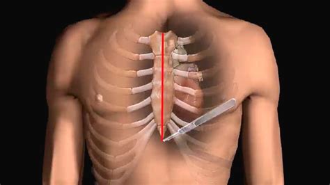 How Does Heart Bypass Surgery Work Coronary Artery Bypass Graft