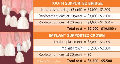 Find out the factors associated with acl surgery costs—and most insurance plans—including medicare and medicaid—cover acl surgery. Comparing the Cost of Implants to Fixed Bridgework