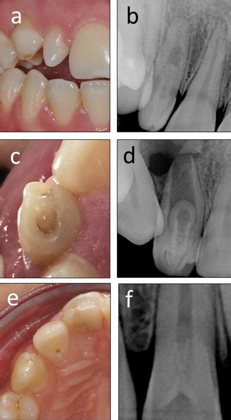 Coronal Anatomical Features Associated With Dens Invaginatus A B