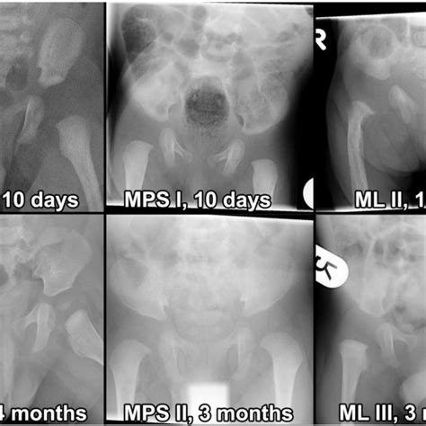 Early Manifestation Of Pelvic Bone Abnormalities In Mps And Ml