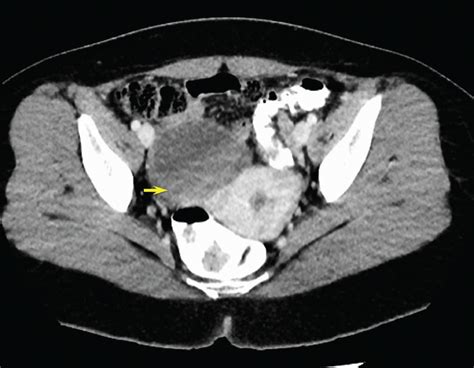 Contrast Enhanced Axial Ct Pelvis Demonstrates A Well Defined Cystic