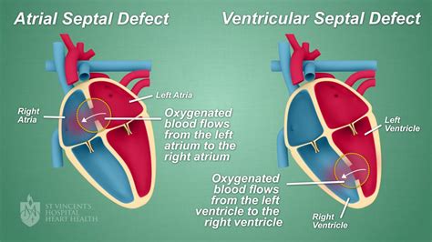Septal Defect Hole In The Heart Closures St Vincents Heart Health