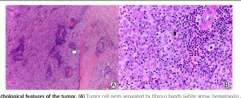 Extrathyroid Carcinoma Showing Thymus Like Differentiation Castle A