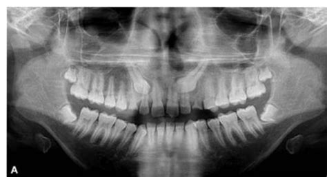 18 Modalities Of Management Of Impacted Canine Pocket
