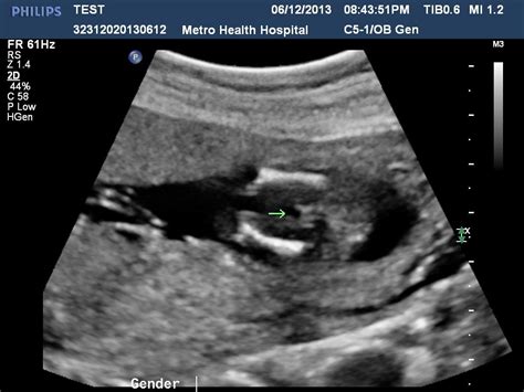 Early Ultrasound Boy Or Girl Rbabybumps