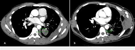 Ct Scans Of The Chest In Patient 1 In June 2017 A And June 2019 B