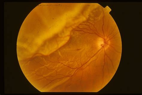 Retinal Detachment With Macular Hole Retina Image Bank