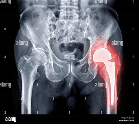 X Ray Pelvic Bone Or Both Hip Joint After Total Hip Replacement