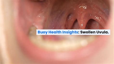 Swollen Uvula Common Causes And When To Seek Medical Care Buoyhealth