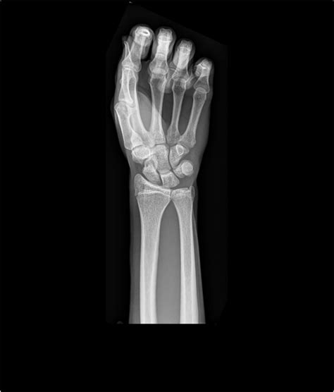 Conventional Radiography Of The Left Wrist And Hand Of A Young