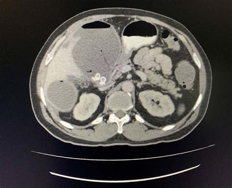 Axial View Of Ct Scan Of The Abdomen With Oral Contrast Demonstrating