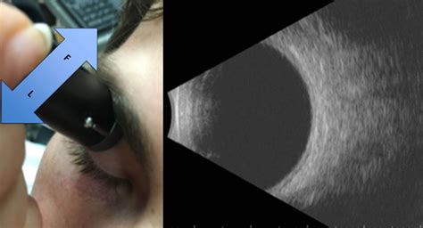 Ocular Ultrasound B Scan Ultrasound Retina Specialists