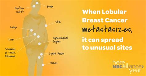 Metastatic Lobular Breast Cancer Metastatic Breast Cancer Alliance