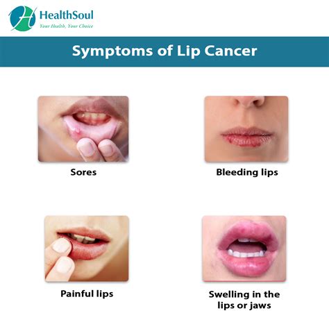 Lip Cancer Causes Symptoms And Treatment Healthsoul