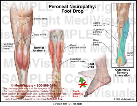 Medivisuals Peroneal Neuropathy Medical Illustration
