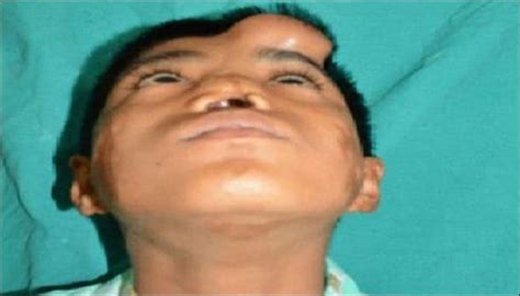 Nose Grown On Forehead Gives 12 Year Old Indian Boy New Lease Of Life