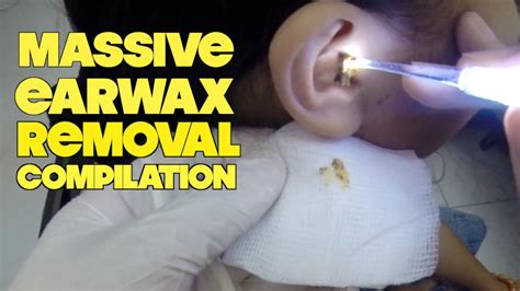 Massive Earwax Removal Compilation Youtube