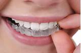 What Is The Price For Braces