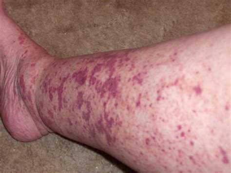 Right Leg Vasculitis Vasculitis Pinterest Legs